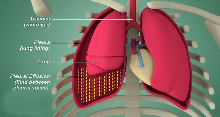  Pleural Effusion Treatment In Noida