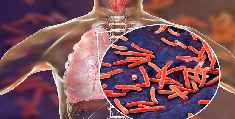 Best Doctor for Tuberculosis in Noida