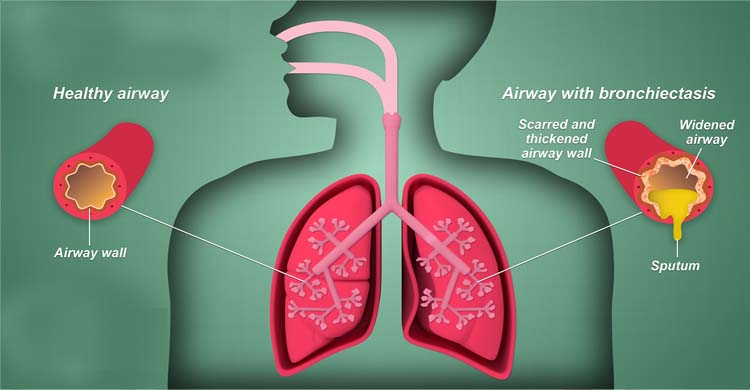 Bronchiectasis treatment in ghaziabad