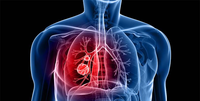 Advanced COPD Treatment in Noida